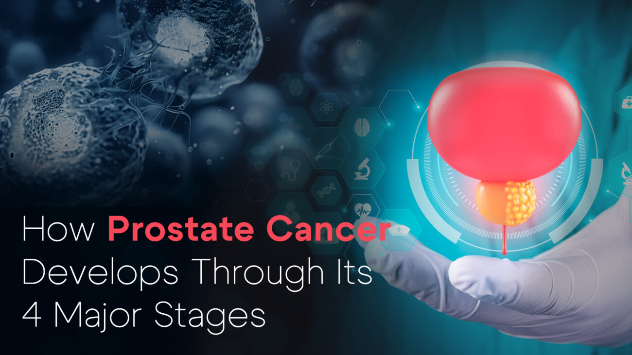 How Prostate Cancer Develops Through Its 4 Major Stages