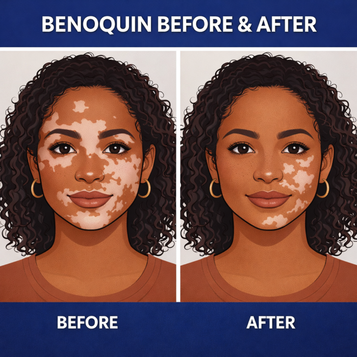 Benoquin cream before and after illustration showing gradual vitiligo depigmentation results on facial skin